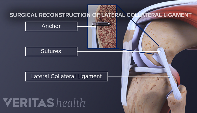 Illustration showing Lateral collateral ligament surgery.
