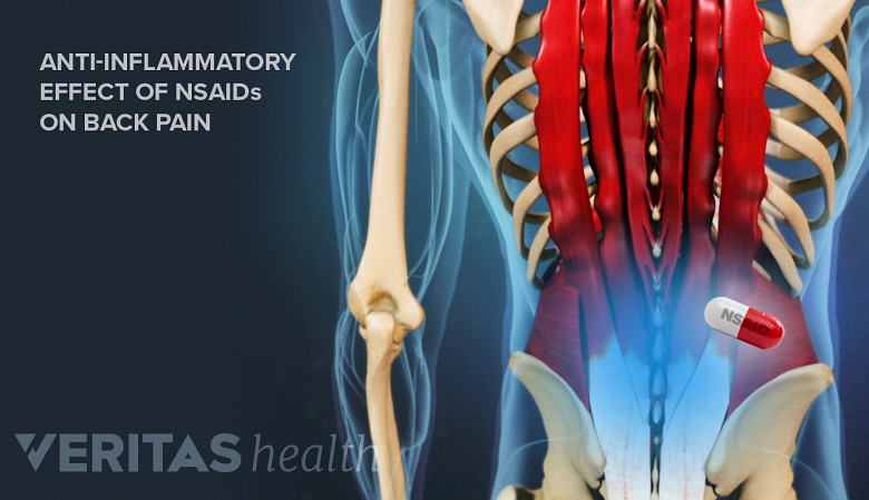 Anti-inflammatory effect of NSAIDs on back pain