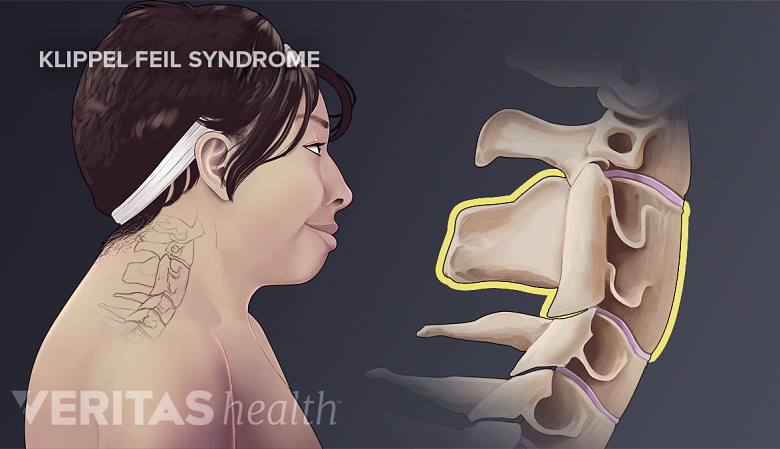 Medical illustration of klippel feil syndrome