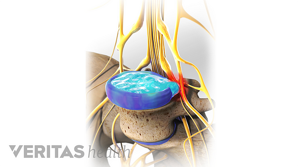 Illustration showing herniated disc.