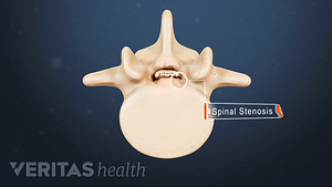 Medical illustration of degenerative spinal stenosis