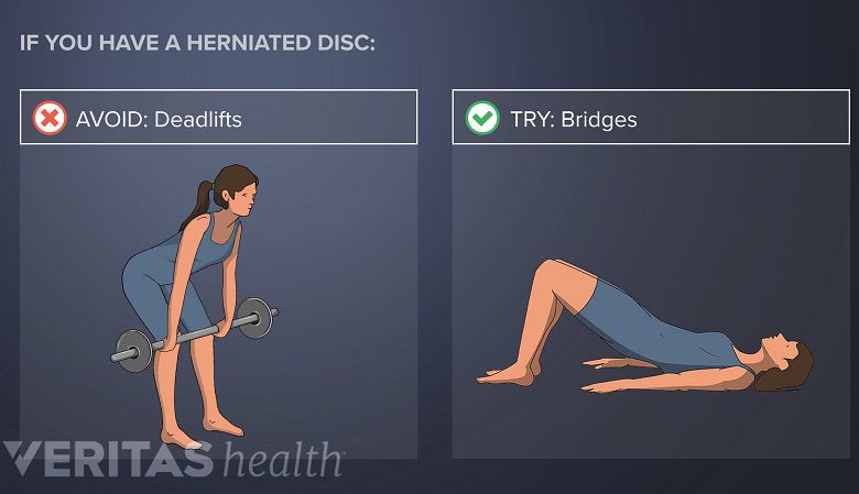 Avoid Deadlifts with lower back disc herniation. Try Bridges.