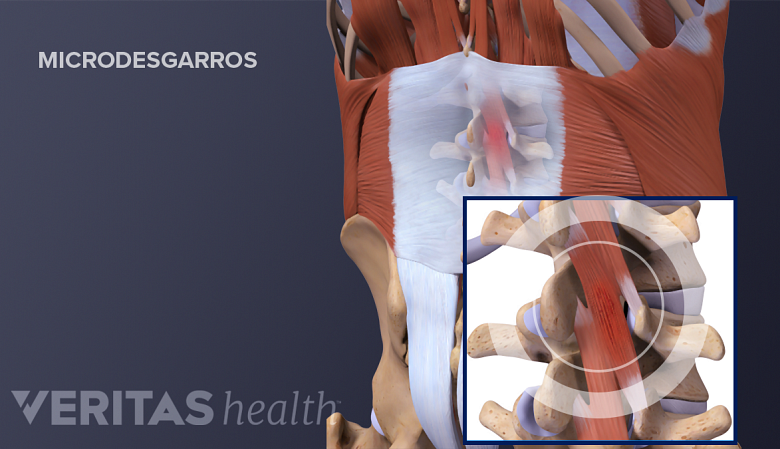 Microdesgarros en los músculos de la espalda inferior.