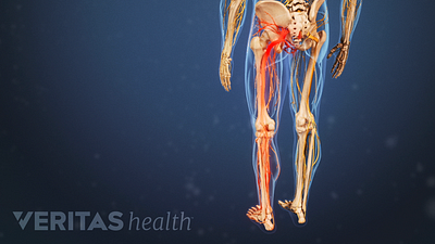 Medical illustration of the torso and upper legs. The sciatic nerve is highlighted in red