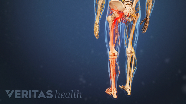 Illustration of pain pattern along the sciatic nerve.
