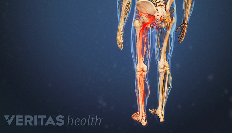 Dolor radicular recorriendo el trayecto del nervio desde la parte baja de la espalda hasta la pierna.