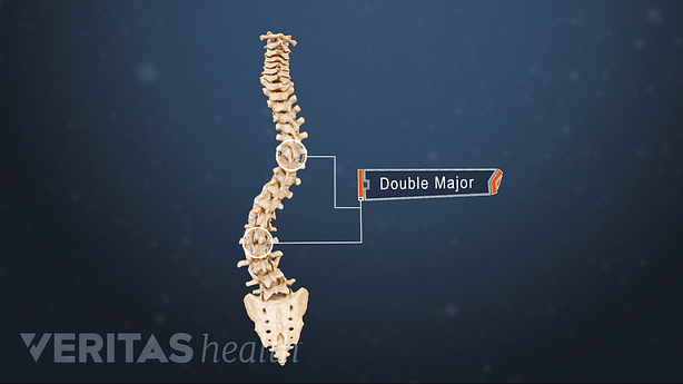 Illustration showing vertebral spine with double major curve.