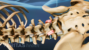 Medical illustration of the lumbar spine with the facet joints highlighted