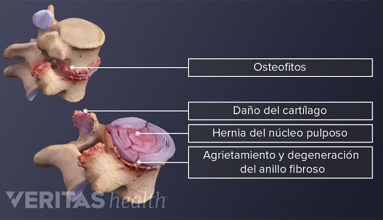 Degeneración vertebral y discal en la columna vertebral.