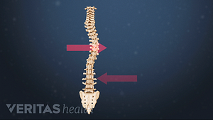Medical illustration of an adolescent spine with scoliosis