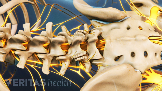 Medical illustration of lumbar osteophytes