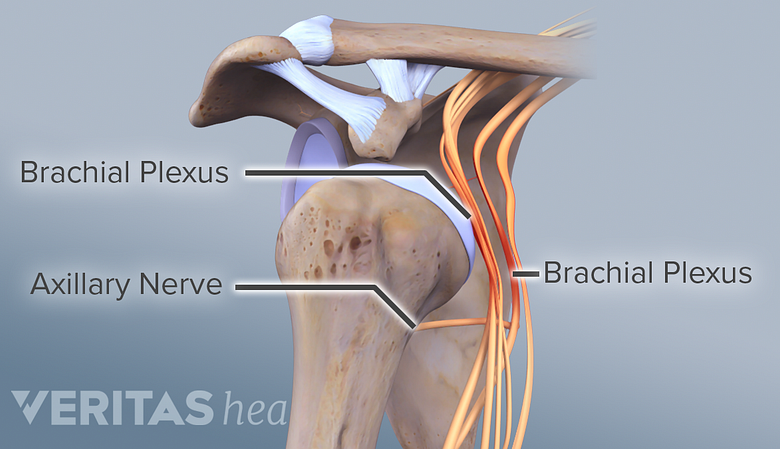 An illustration showing brachial plexus impingement.
