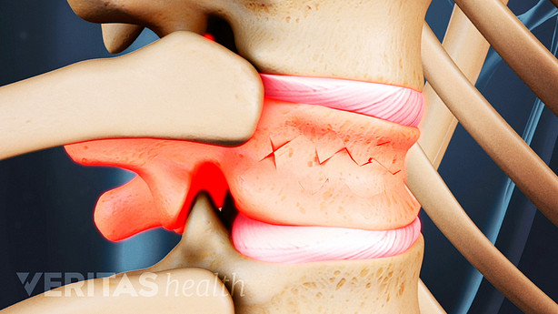 Fractura espinal por compresión de una vértebra en la columna vertebral.