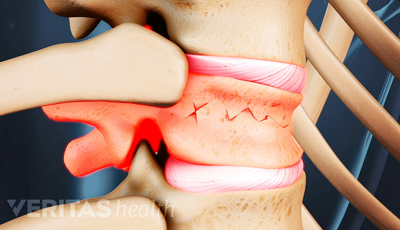 Fractura espinal por compresión de una vértebra en la columna vertebral.