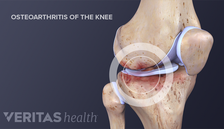 Medical illustration of osteoarthritic changes in the knee joint