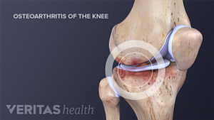 Skeletal view of osteoarthritis in the knee