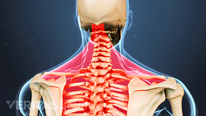 Posterior view of the upper body highlighting pain in the shoulders, neck, and upper back.