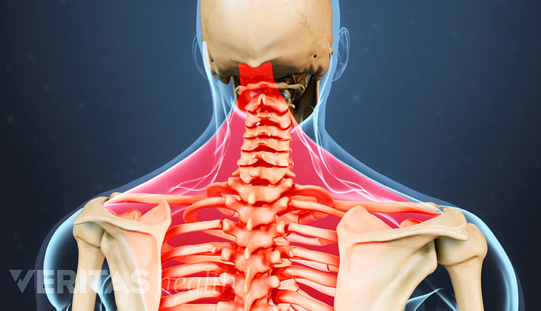 An illustration showing a adult spine with muscles of neck and upper back highlighted in red.