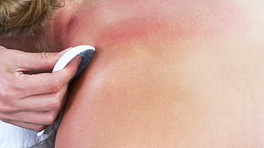 Red splotches on a woman&#039;s neck and upper back from gua sha treatment