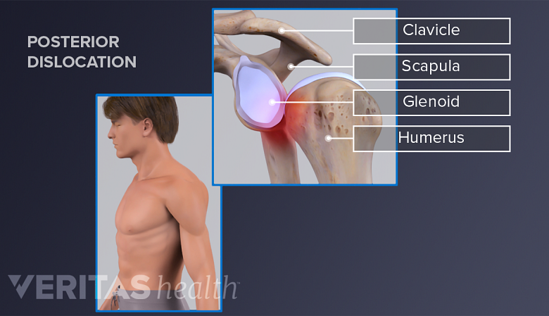 Illustration showing a man with posterior shoulder dislocation and an inset showing anatomy of shoiulder joint with dislocation.