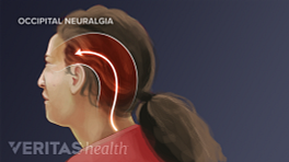 Profile view of occipital neuralgia headache throughout the skull.