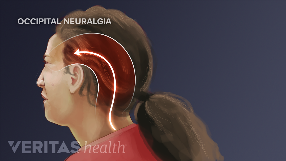 Diagram of woman highlighting areas of the head and neck affected by an occipital neuralgia headache.