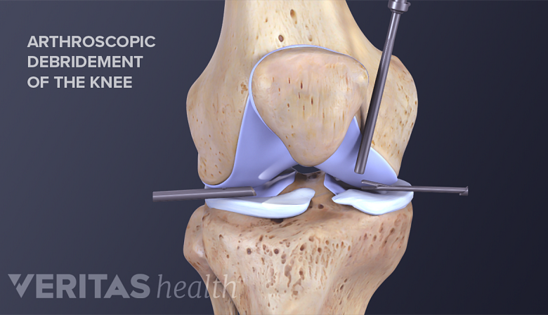Illustration showing surgical debridement of the damaged knee cartilage.