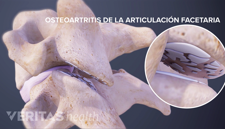 Osteoartritis de la articulación facetaria.
