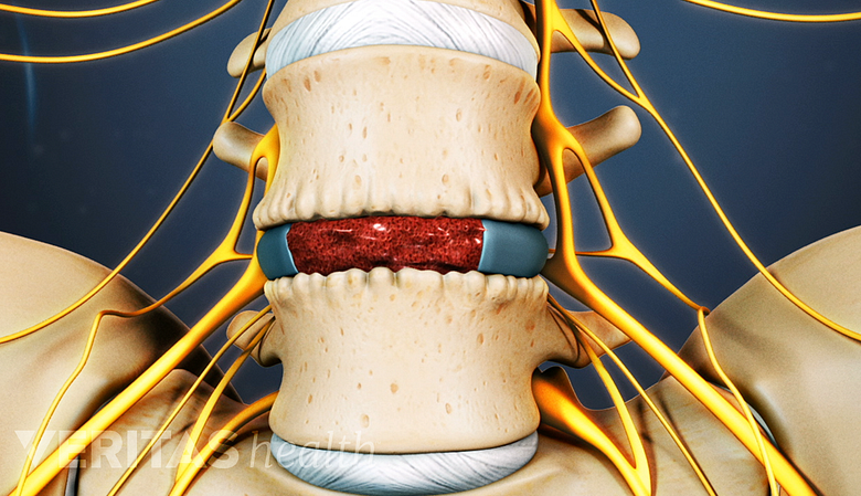 Bone graft filled into a disc space in the lower back.
