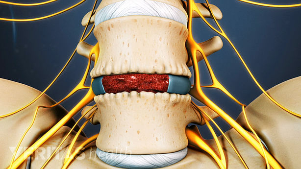 Medical illustration of a bone graft and cage in the spine