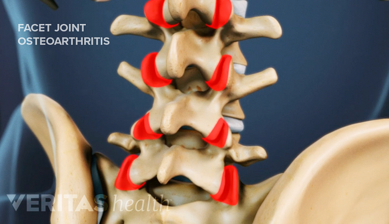 Illustration showing facet joint arthritis highlighted in red.