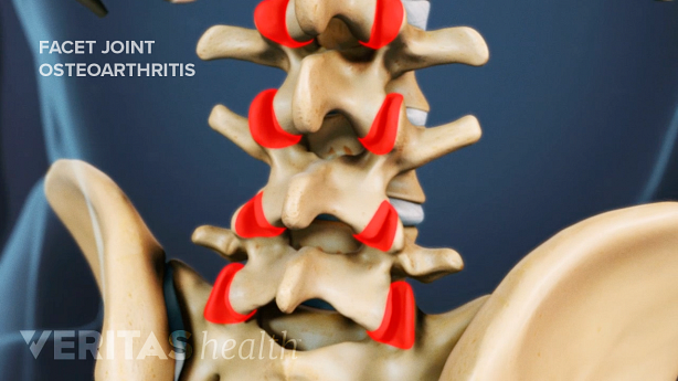 Illustration showing facet joint arthritis highlighted in red.