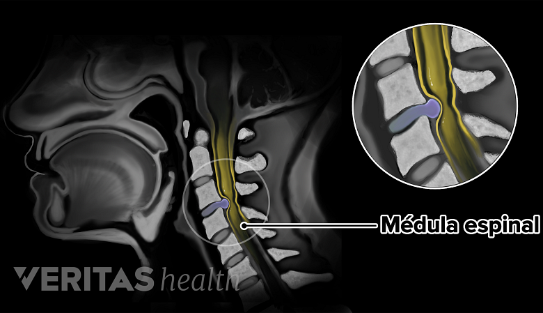 Resonancia magnética de una hernia de disco cervical.