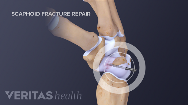 Scaphoid fracture repair