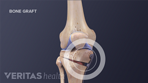 Medical illustration showing parts of the bone that are removed during a tibial osteotomy.