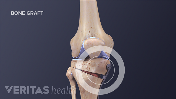 Medical illustration showing parts of the bone that are removed and bone grafts added during a tibial osteotomy.
