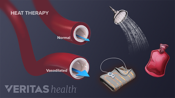 Normal and vasilodated blood vessels as a response to different forms of heat therapy