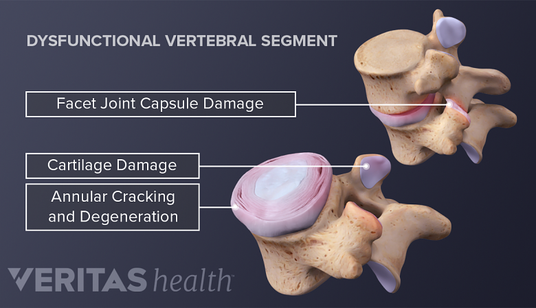 An illustration showing vertebral segment showing degeneration.