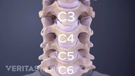 前视宫颈脊柱显示C3-C6