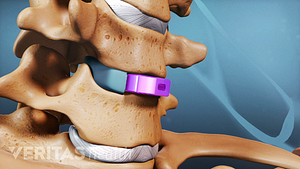 Medical illustration showing anterior cervical discectomy and fusion (ACDF) for cervical degenerative disc disease