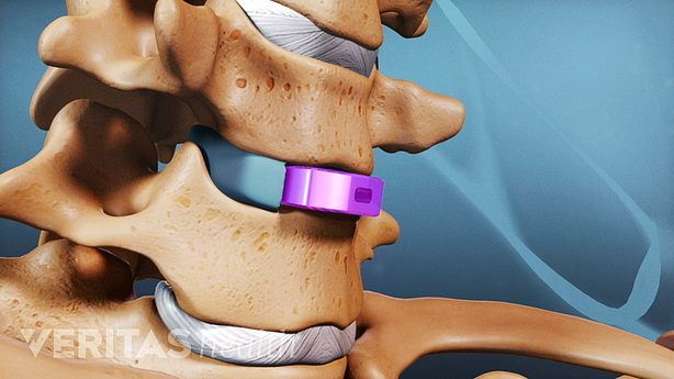 Bone graft inserted between two vertebra.