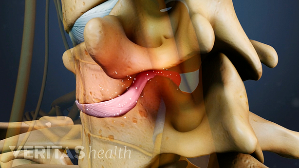 Vista de perfil para mostrar un disco degenerativo cervical entre dos vértebras.