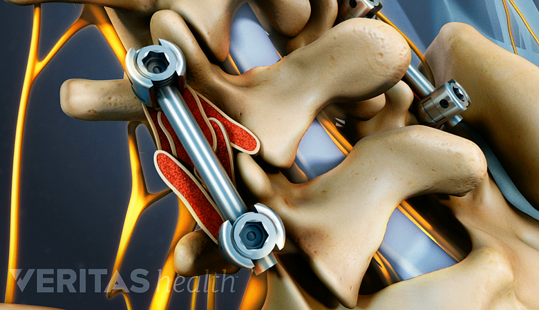 Illustration showing pedicle screws and rods in the fusion surgery.