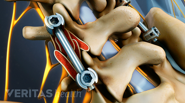 Screws and rods in two vertebra of the lumbar spine.