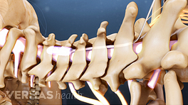 Spinal cord leads in the cervical spine.