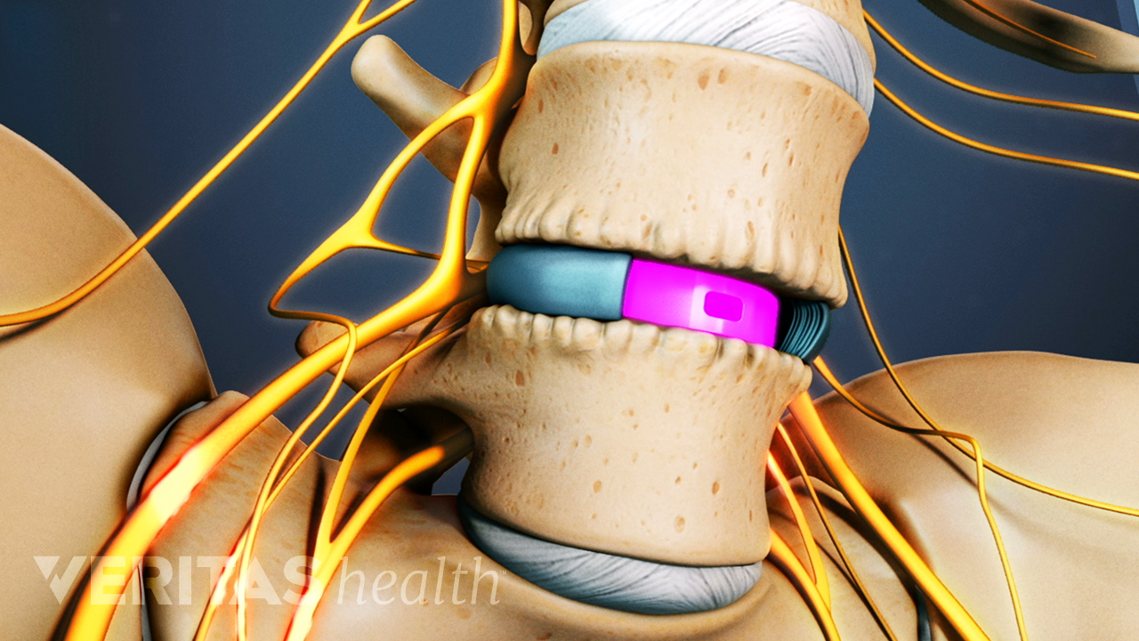 Anterior Lumbar Interbody Fusion (ALIF) Surgery | Spine-health