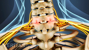 Posterior view of bone spurs in the cervical spine