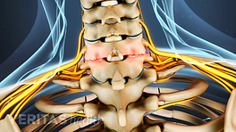 Posterior view of cervical spine showing facet joint swelling from osteoarthritis.