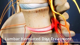 5 Little-Known Tips for Lumbar Herniated Disc Pain Relief