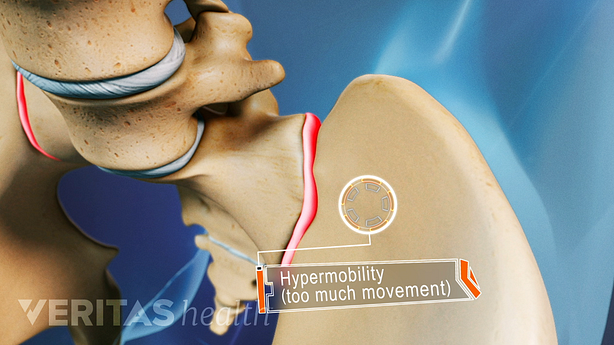 Hypermobility in the sacroiliac joint